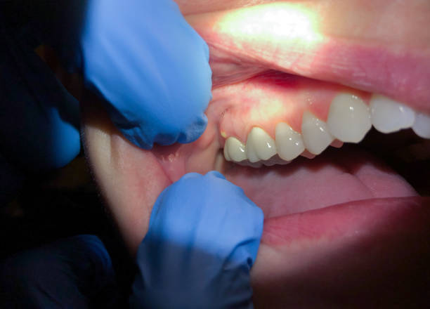 Best Dental Abscess Treatment in Midland Park, NJ