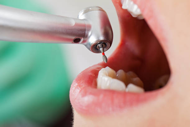 Best Emergency Wisdom Tooth Extraction in Midland Park, NJ